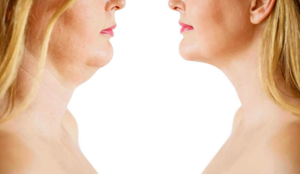 Double Chin treatment Hackney Wick before and after results