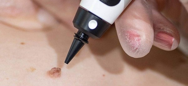 After Skin Tag Removal Hackney Wick