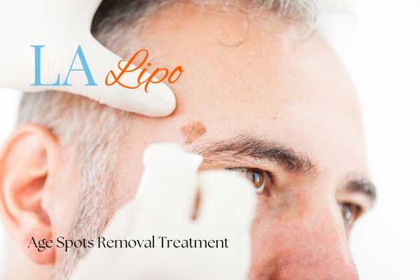 What Are the Most Effective Treatments for Age Spots Hackney Wick?
