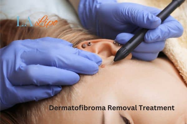 Dermatofibroma Removal Treatment Hackney Wick