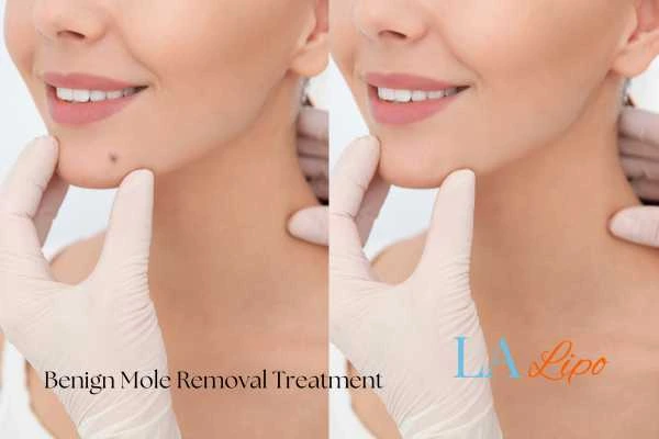 woman's before and after mole removal Hackney Wick results