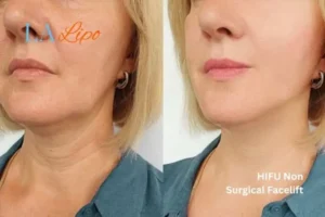 hi-fu for wrinkles Hackney Wick before and after results