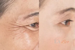 Before and after results of woman - HI-fu wrinkles reduction treatment Hackney Wick
