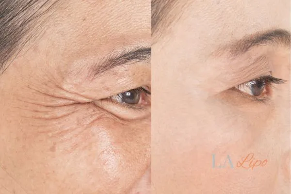 Before and after results of woman - HI-fu wrinkles reduction treatment Hackney Wick