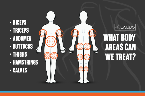 Graphic to show areas you can have LA-EMS Body Sculpting Hackney Wick treatment.