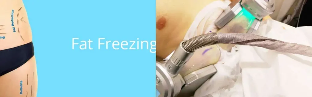 Fat freezing Hackney Wick on multiple areas of the body