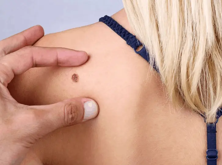 woman having mole removal Hackney Wick consultation before treatment.