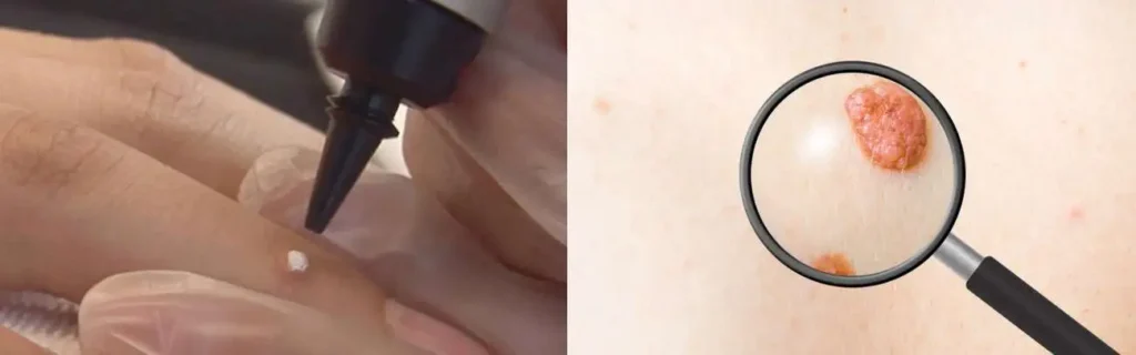 Cryopen for mole removal Hackney Wick - speak to our team today!