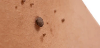 image of a skin tag Hackney Wick