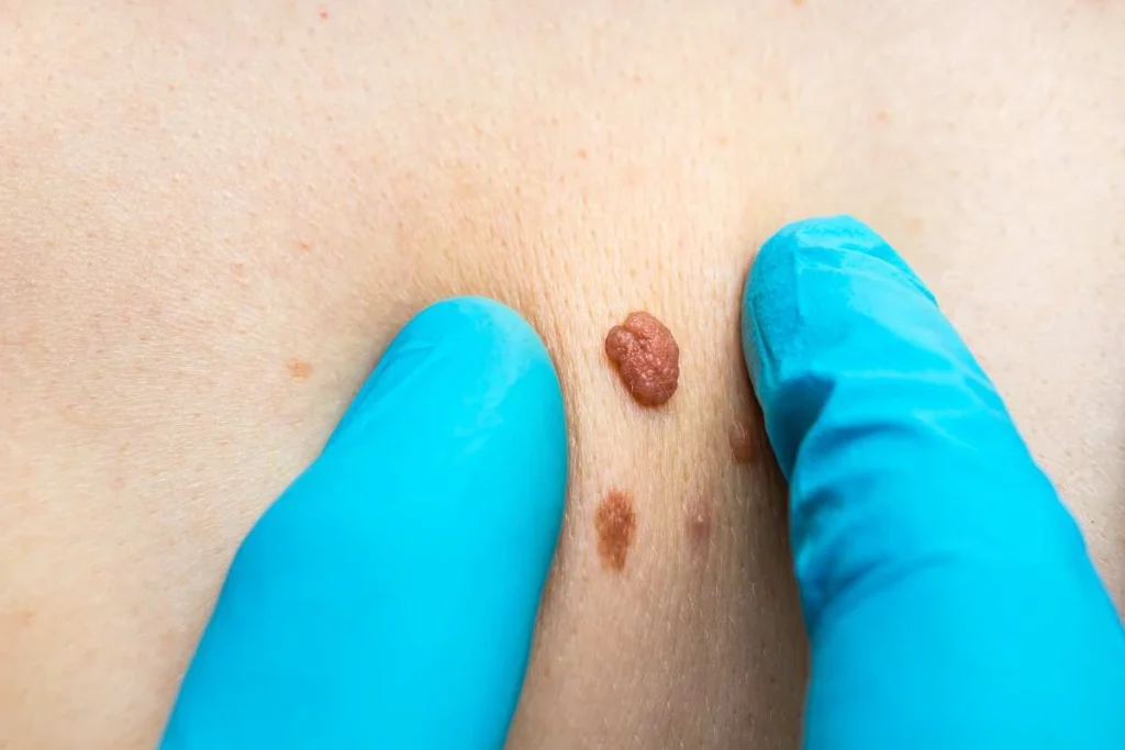 Consultant examining a skin tag Hackney Wick