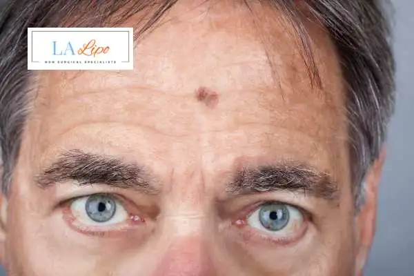 Solar Lentigo Removal Hackney Wick image of man with mark on his forehead