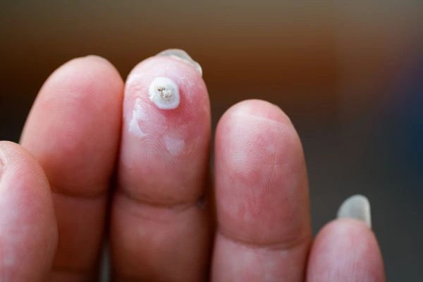 wart on person finger - cryotherapy to treat from LA LIPO Hackney Wick