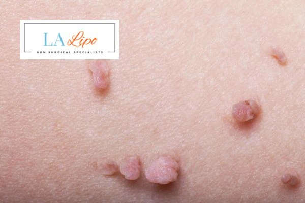 Does cryopen skin tag removal Hackney Wick hurt? Find out now call our team today!