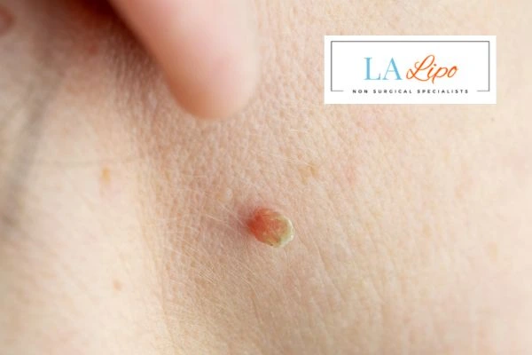 Book skin tag removal Hackney Wick today speak to our team now!