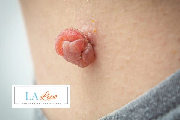 Interested in skin tag removal Hackney Wick? Concerned about the pain? Find out more today!