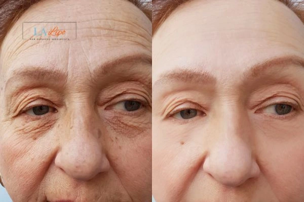 The powerful benefits of Morpheus8 Treatment Hackney Wick - Call Our team today!