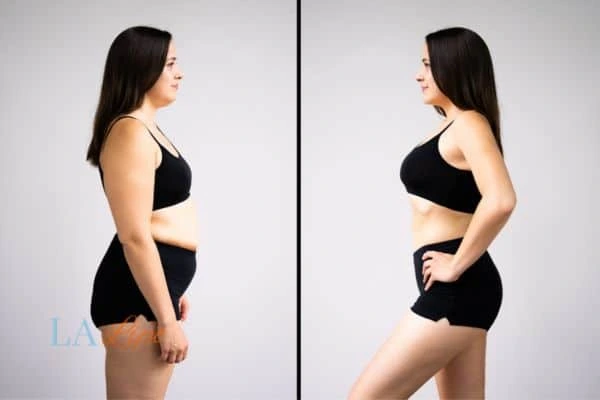 Picture of womans before and after using LA-EMS body sculpting to improve her core strength Hackney Wick