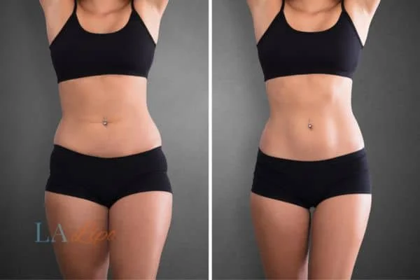 before and after results of non-surgical treatment to help a woman's body image and mental health Hackney Wick