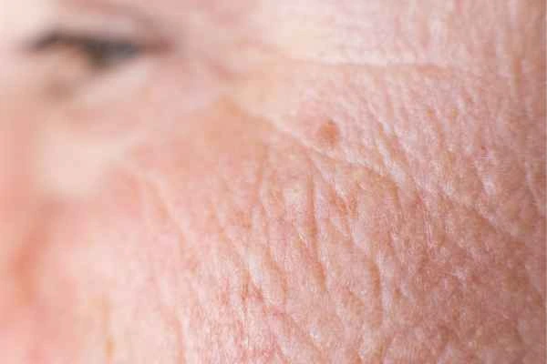 close up picture of a woman's face showing an age spot Hackney Wick