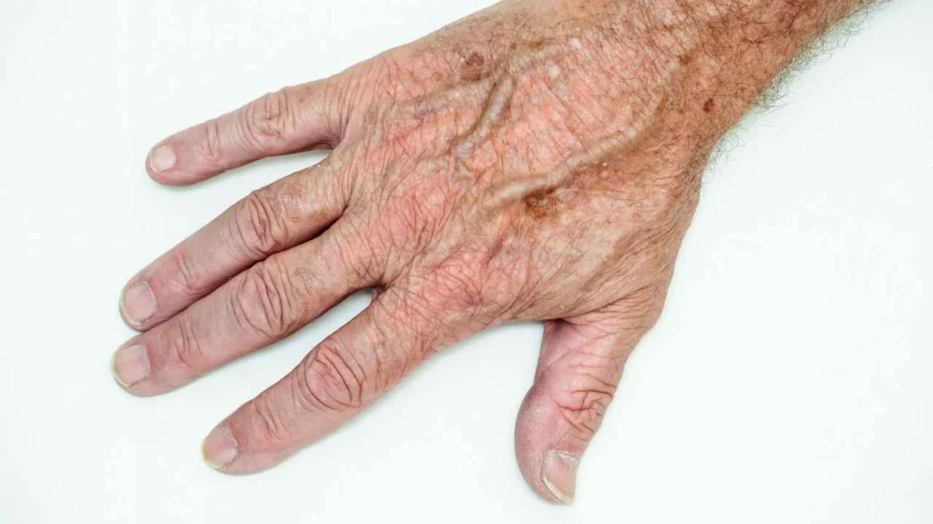 Male hand showing age spot Hackney Wick
