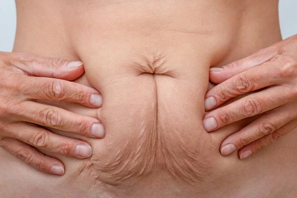 Image of a woman's stomach with loose skin - example of skin tightening Hackney Wick options